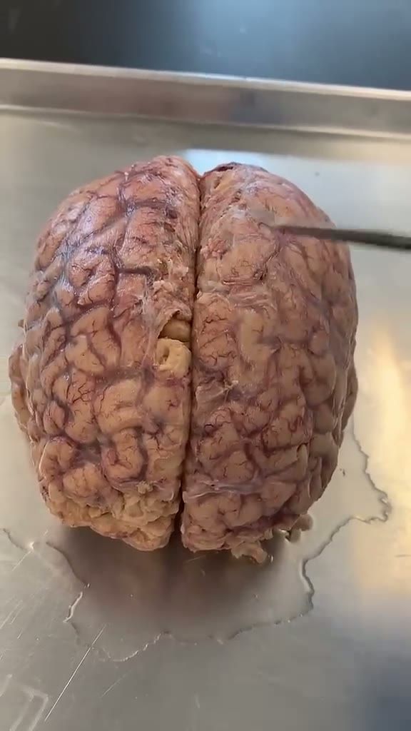 This Separates the Brain Hemispheres - Institute of Human Anatomy (720p, h264)
